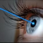 تقنية الفيمتو ليزك (Femto-LASIK)