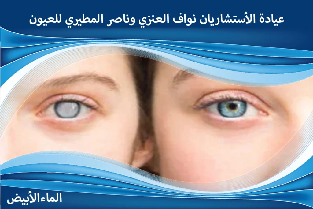 تكلفة عملية المياه البيضاء في الرياض