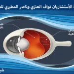 سعر عملية انفصال الشبكية