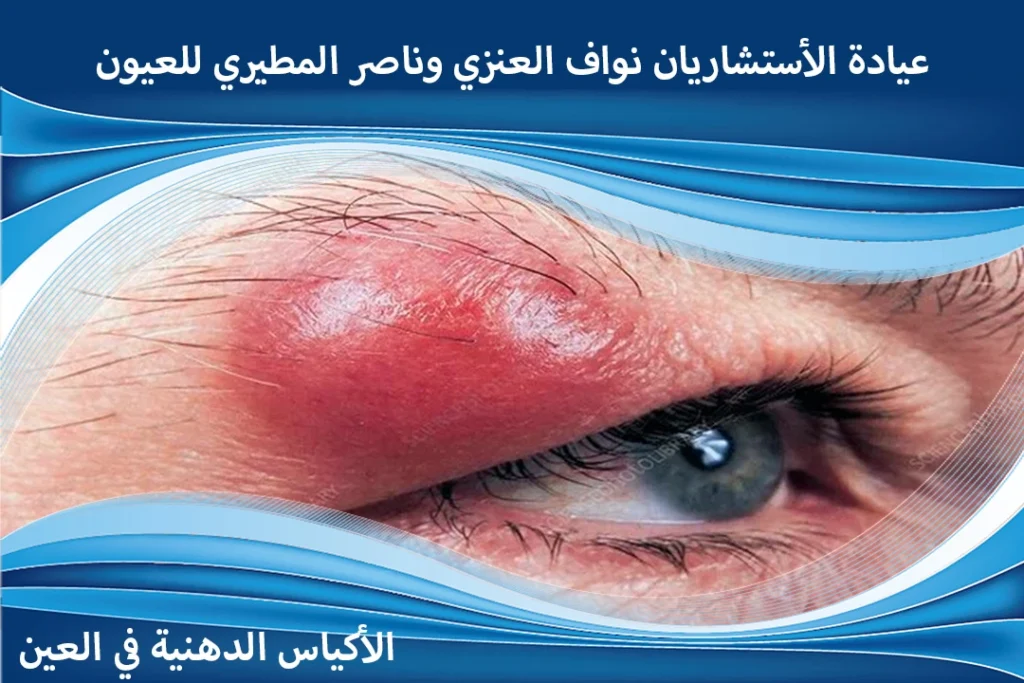انواع الاكياس الدهنية في العين