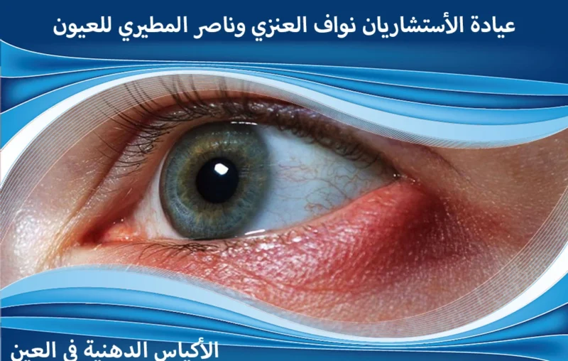 انواع الاكياس الدهنية في العين