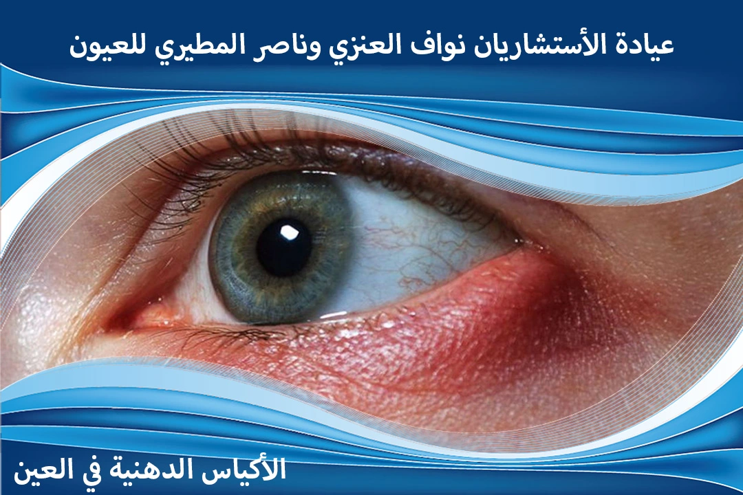 انواع الاكياس الدهنية في العين