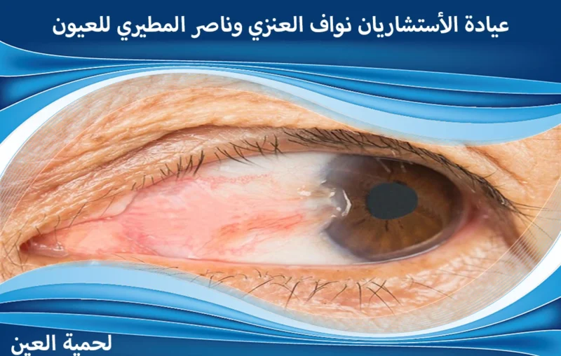 ماهو علاج لحمية العين