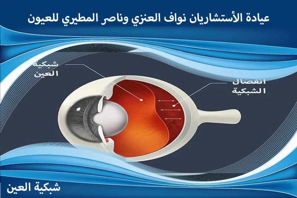 عروض عملية انفصال الشبكية