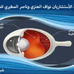 عروض عملية انفصال الشبكية
