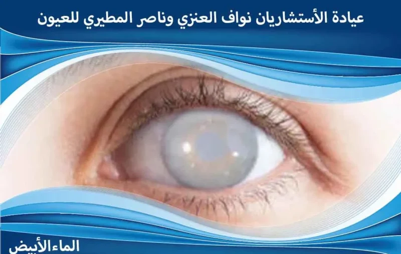 إزالة الماء الأبيض