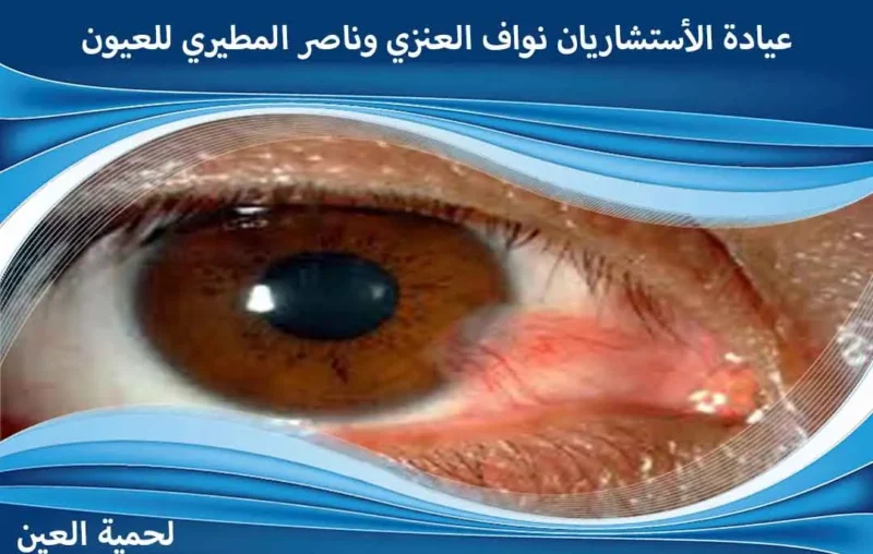 أسباب لحمية العين