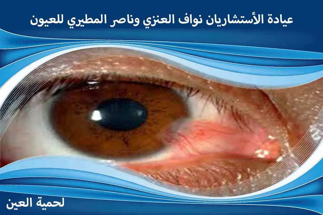 أسباب لحمية العين