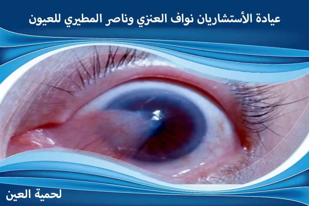 اللحمية في العين لحمية العين ظفر العين زوائد لحمية