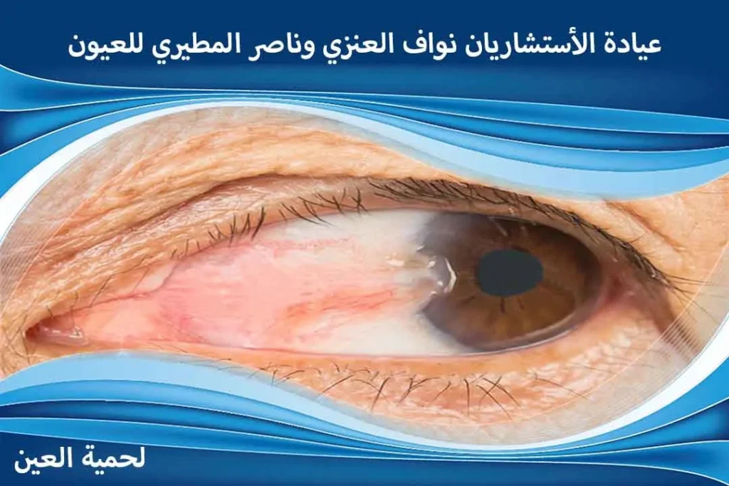 اللحمية في العين لحمية العين ظفر العين زوائد لحمية