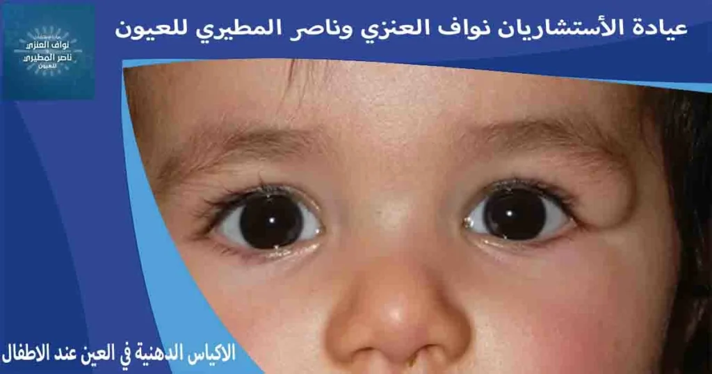 الاكياس الدهنية في العين عند الاطفال علاج الاكياس الدهنيه في العين عند الاطفال الكيس الدهني في العين للاطفال