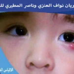 الاكياس الدهنية في العين عند الاطفال علاج الاكياس الدهنيه في العين عند الاطفال الكيس الدهني في العين للاطفال