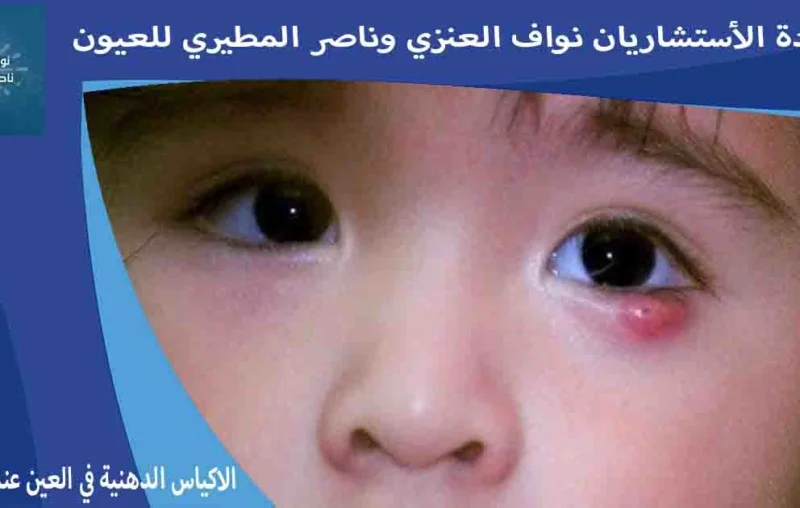 الاكياس الدهنية في العين عند الاطفال علاج الاكياس الدهنيه في العين عند الاطفال الكيس الدهني في العين للاطفال