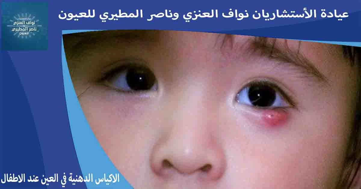 الاكياس الدهنية في العين عند الاطفال علاج الاكياس الدهنيه في العين عند الاطفال الكيس الدهني في العين للاطفال