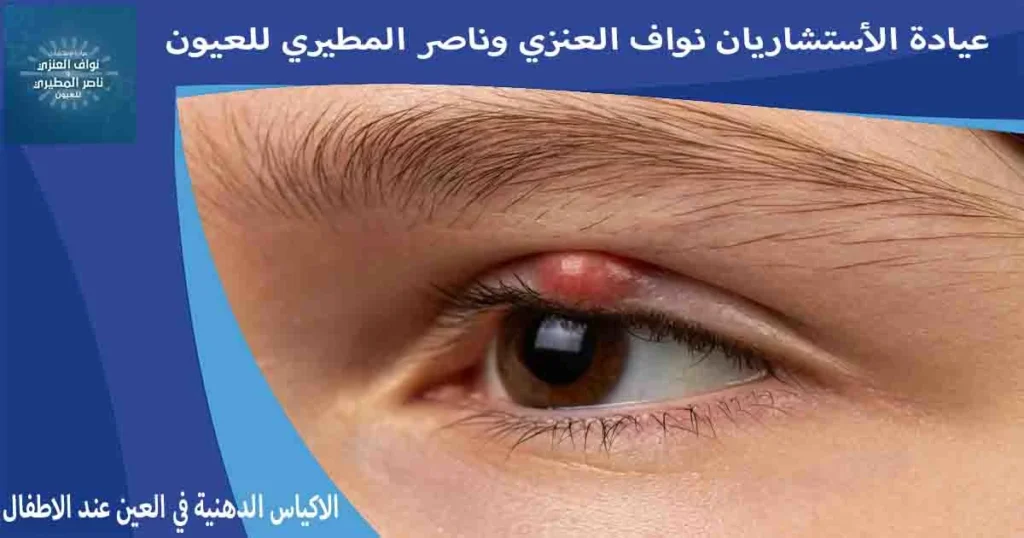 الاكياس الدهنية في العين عند الاطفال علاج الاكياس الدهنيه في العين عند الاطفال الكيس الدهني في العين للاطفال