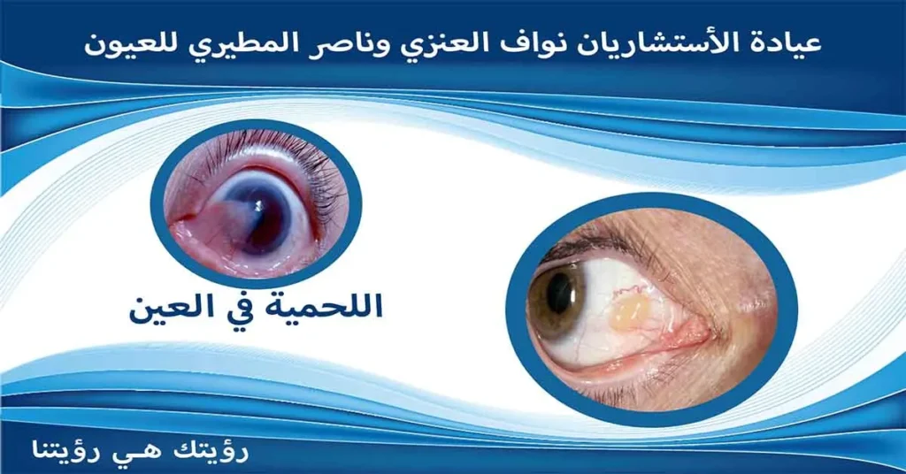 اللحمية في العين لحمية العين ظفر العين زوائد لحمية