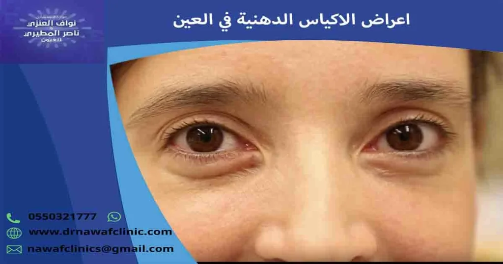 اعراض الاكياس الدهنية في العين
اعراض الاكياس الدهنية