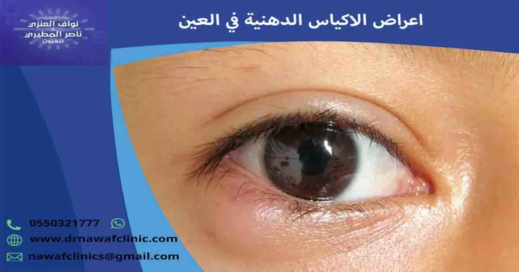 اعراض الاكياس الدهنية في العين
اعراض الاكياس الدهنية