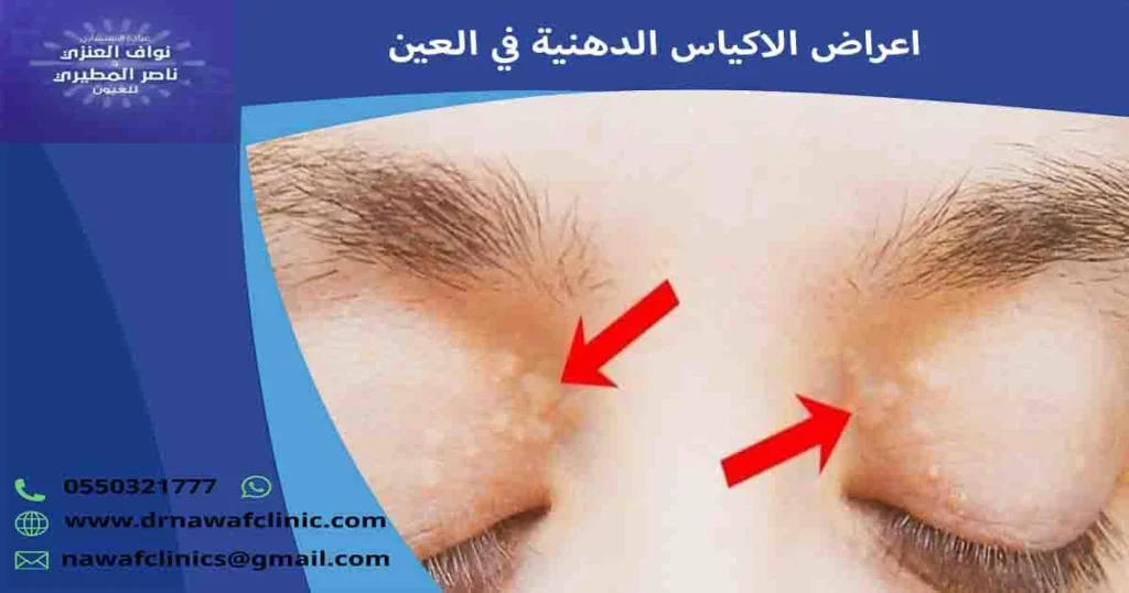 اعراض الاكياس الدهنية في العين
اعراض الاكياس الدهنية