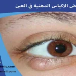 اعراض الاكياس الدهنية في العين  اعراض الاكياس الدهنية