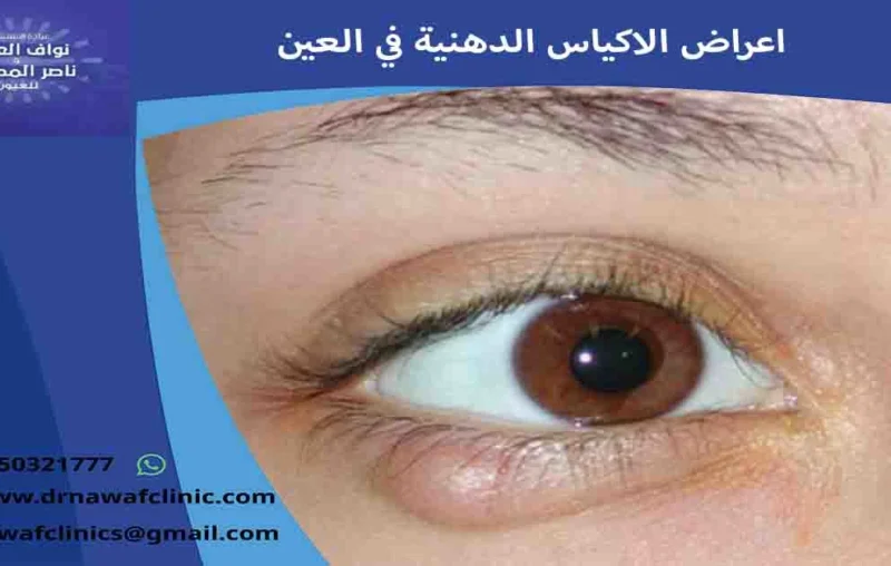 اعراض الاكياس الدهنية في العين اعراض الاكياس الدهنية