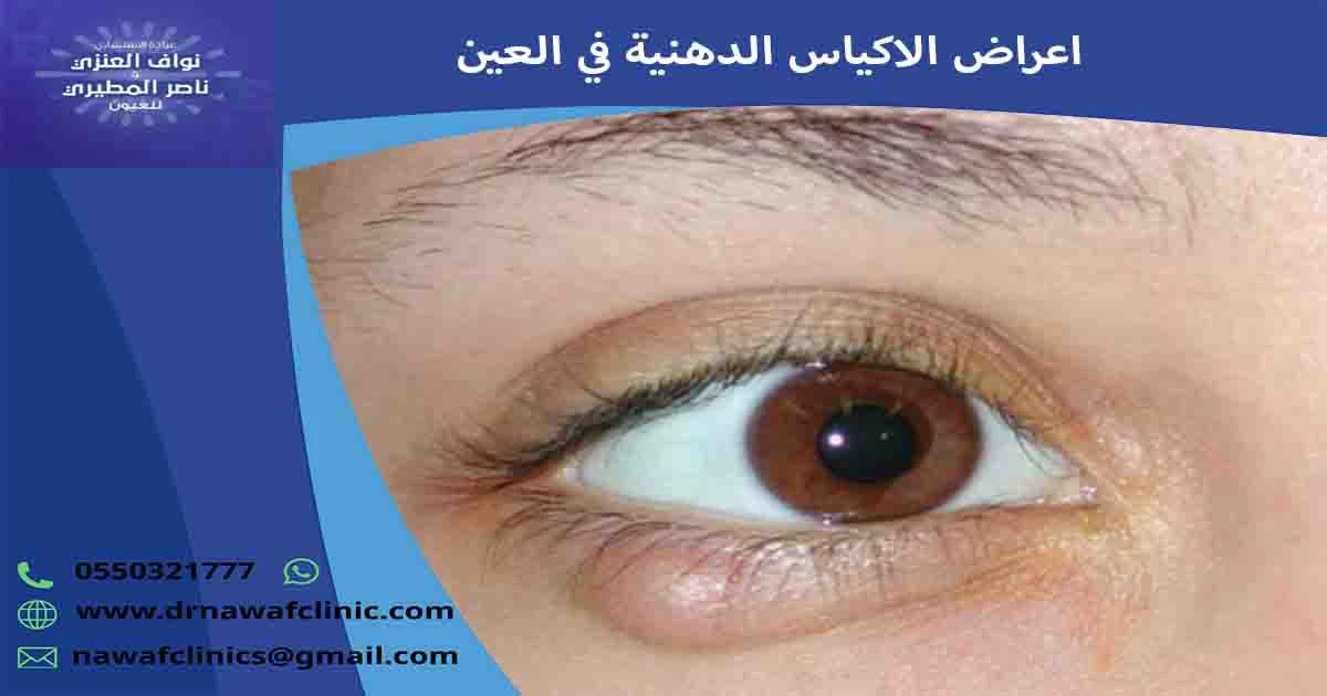 اعراض الاكياس الدهنية في العين اعراض الاكياس الدهنية
