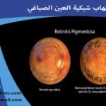 التهاب الشبكية الصباغي التهاب شبكية العين الصباغي التهاب الشبكيه الصباغي