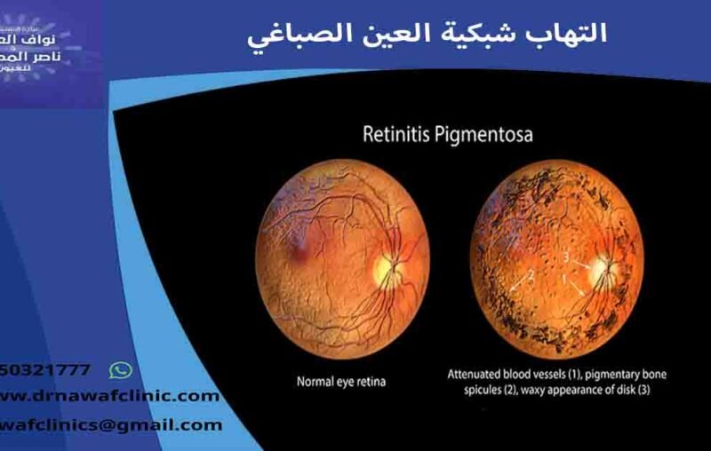 التهاب الشبكية الصباغي التهاب شبكية العين الصباغي التهاب الشبكيه الصباغي