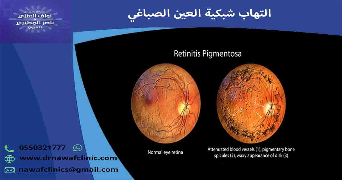 التهاب الشبكية الصباغي التهاب شبكية العين الصباغي التهاب الشبكيه الصباغي
