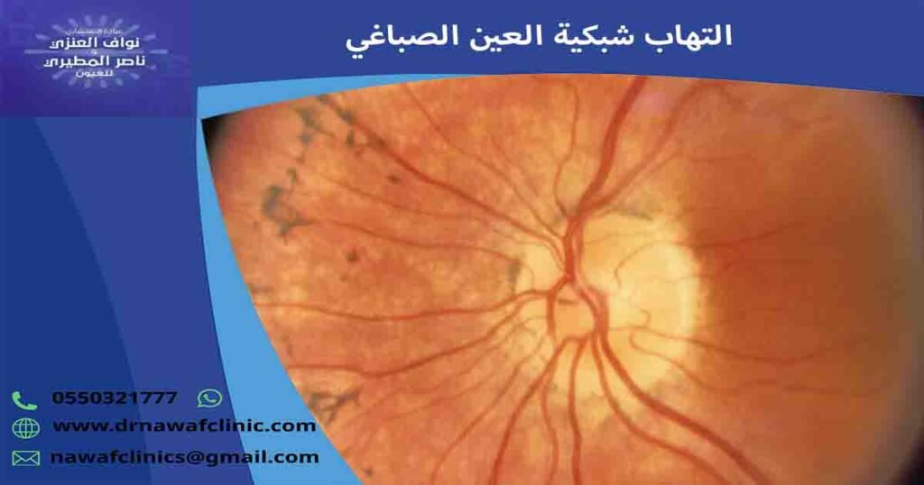 التهاب الشبكية الصباغي
التهاب شبكية العين الصباغي
التهاب الشبكيه الصباغي