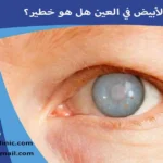 الماء الأبيض في العين هل هو خطير؟ هل الماء الأبيض في العين خطير؟ ما خطورة المياه البيضاء على العين؟