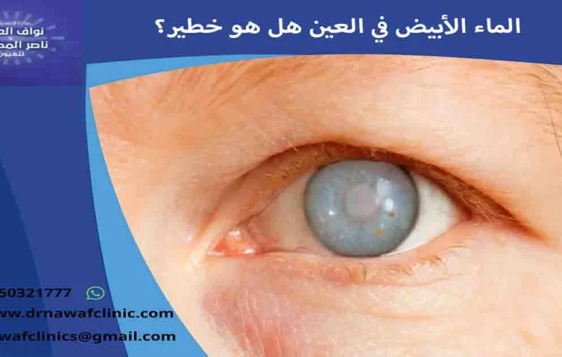 الماء الأبيض في العين هل هو خطير؟ هل الماء الأبيض في العين خطير؟ ما خطورة المياه البيضاء على العين؟