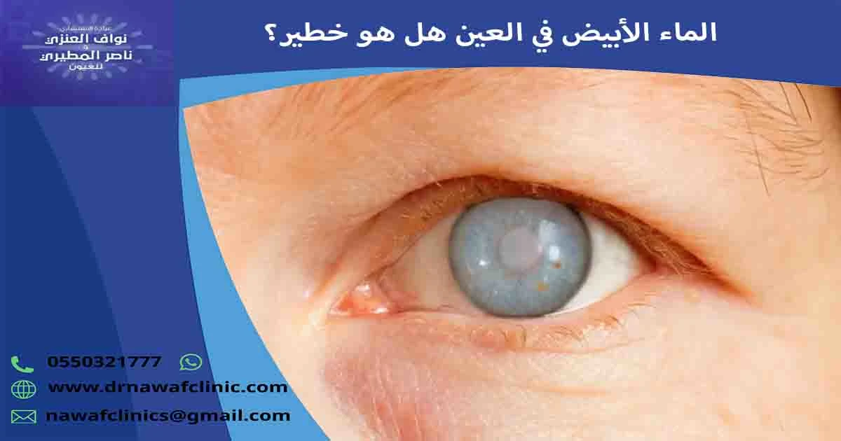 الماء الأبيض في العين هل هو خطير؟ هل الماء الأبيض في العين خطير؟ ما خطورة المياه البيضاء على العين؟