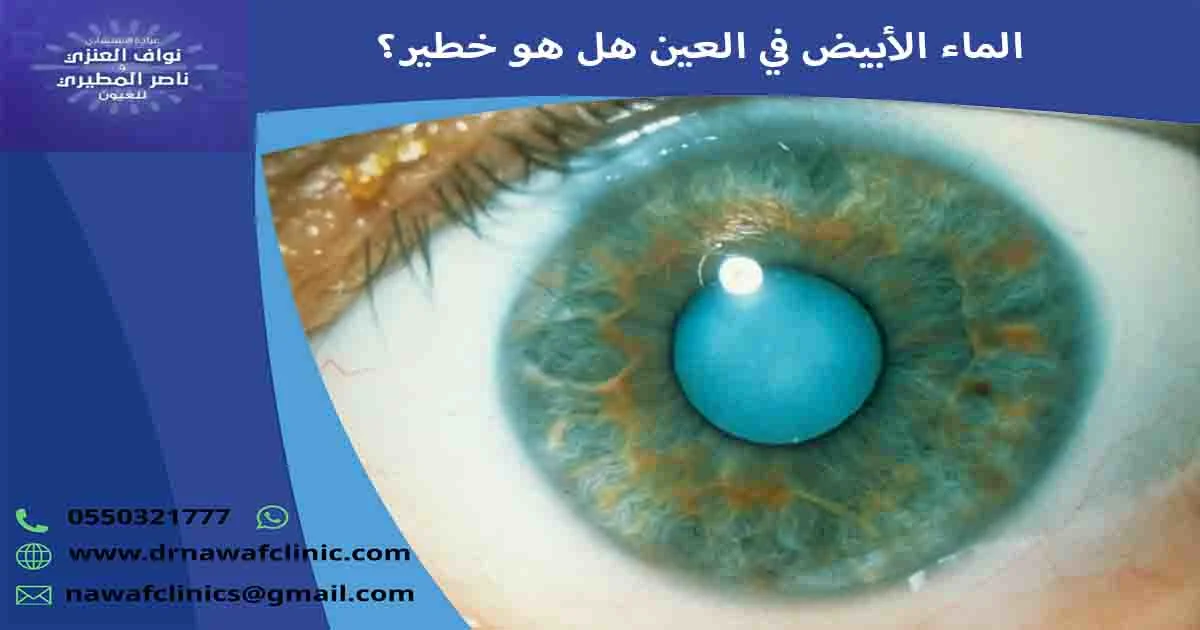 الماء الأبيض في العين هل هو خطير؟ هل الماء الأبيض في العين خطير؟ ما خطورة المياه البيضاء على العين؟