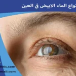 انواع الماء الابيض في العين أنواع إعتام عدسة العين