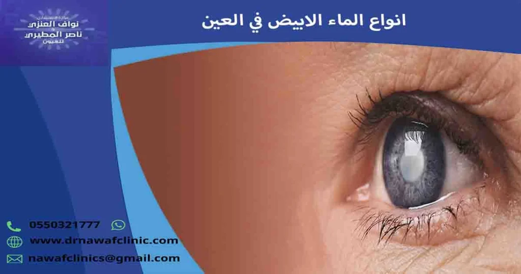 انواع الماء الابيض في العين
أنواع إعتام عدسة العين
