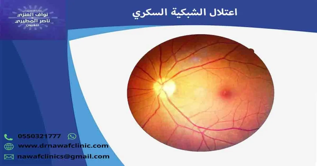 اعتلال الشبكية السكري
اعتلال الشبكيه السكريه