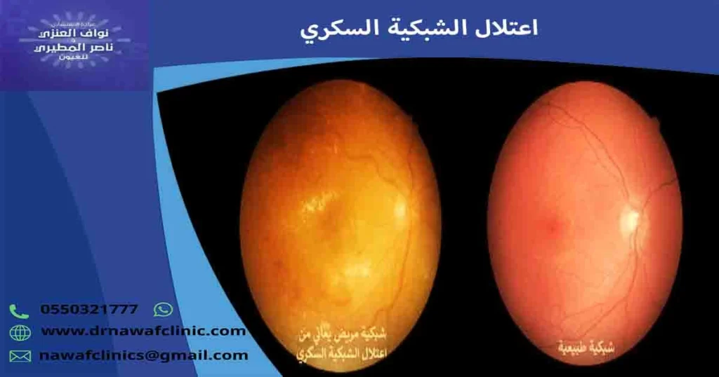 اعتلال الشبكية السكري
اعتلال الشبكيه السكريه