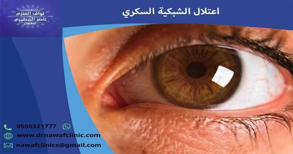 اعتلال الشبكية السكري
اعتلال الشبكيه السكريه