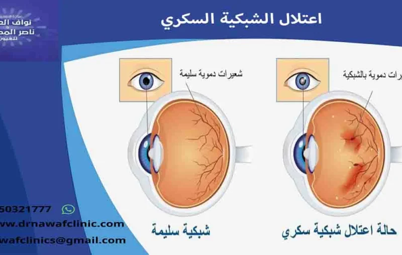 اعتلال الشبكية السكري اعتلال الشبكيه السكريه