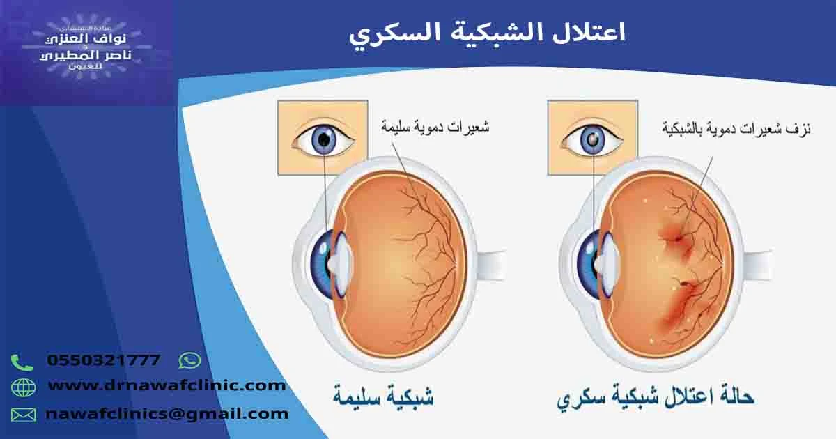 اعتلال الشبكية السكري اعتلال الشبكيه السكريه