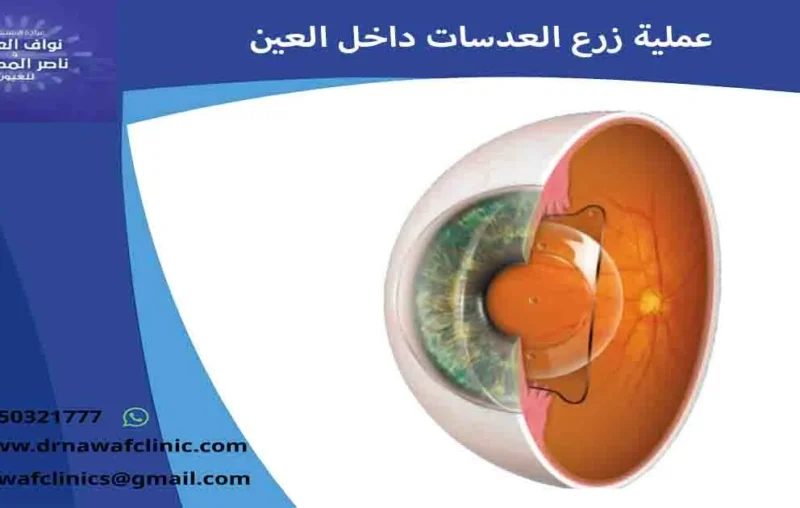 عملية زرع العدسات داخل العين زراعة عدسه للعين زراعة عدسات العين زراعة العدسة عملية زراعة عدسة العين