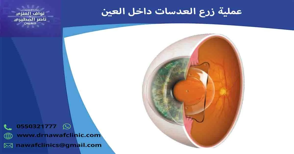 عملية زرع العدسات داخل العين زراعة عدسه للعين زراعة عدسات العين زراعة العدسة عملية زراعة عدسة العين